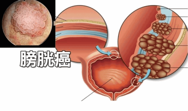 為什麼男性更容易膀胱癌 膀胱癌的早期症狀有哪些