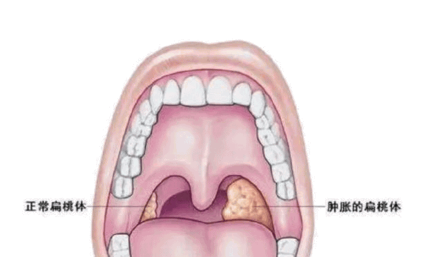 男性扁桃体图片